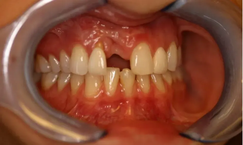 Clinical photo from Hope's smile reconstruction case